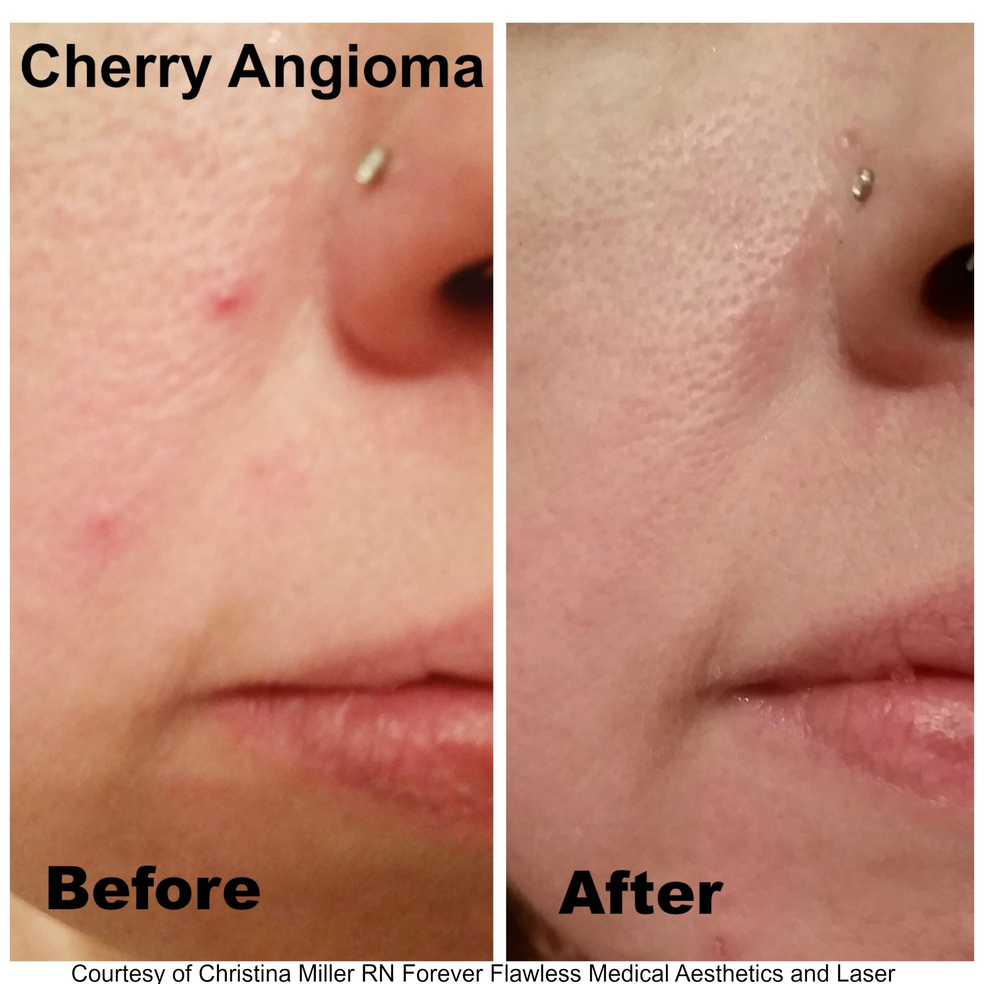 Skin Classic Cherry before and after