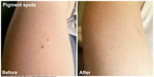 Skin Classic arm spot before and after