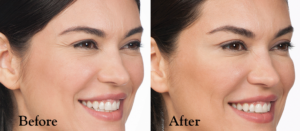 Cynthia Crows Feet Before and After Botox