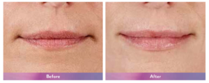 Juvederm Ultra XC Before and After 2
