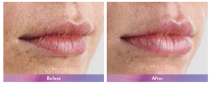 Juvederm Ultra XC Before and After