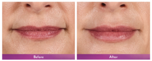 Juvederm Volbella Before and After 4