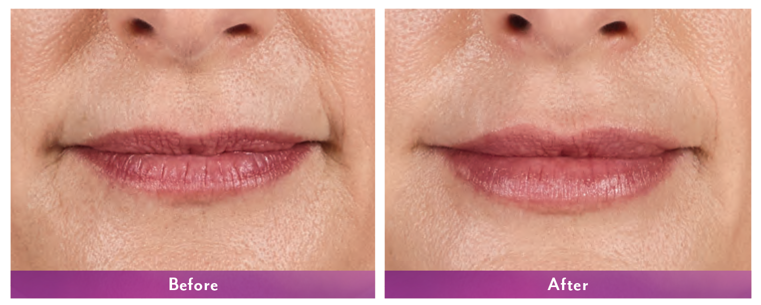 Juvederm Volbella Before and After 4