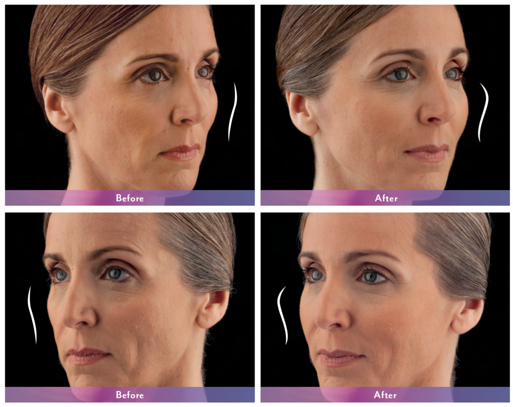 Juvederm Voluma Before and After Forever Flawless