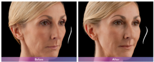 Juvederm Voluma Before and After 3