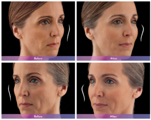 Juvederm Voluma Before and After