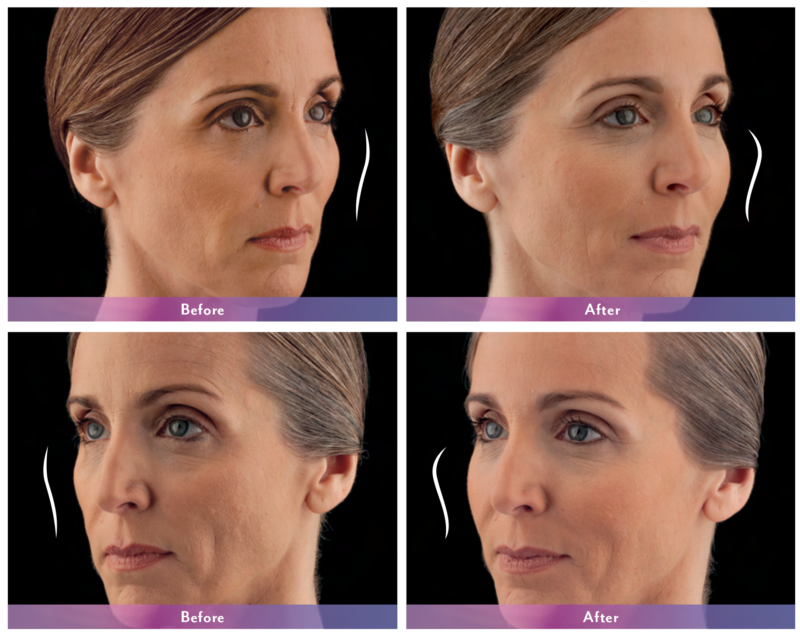 Juvederm Voluma Before and After Forever Flawless