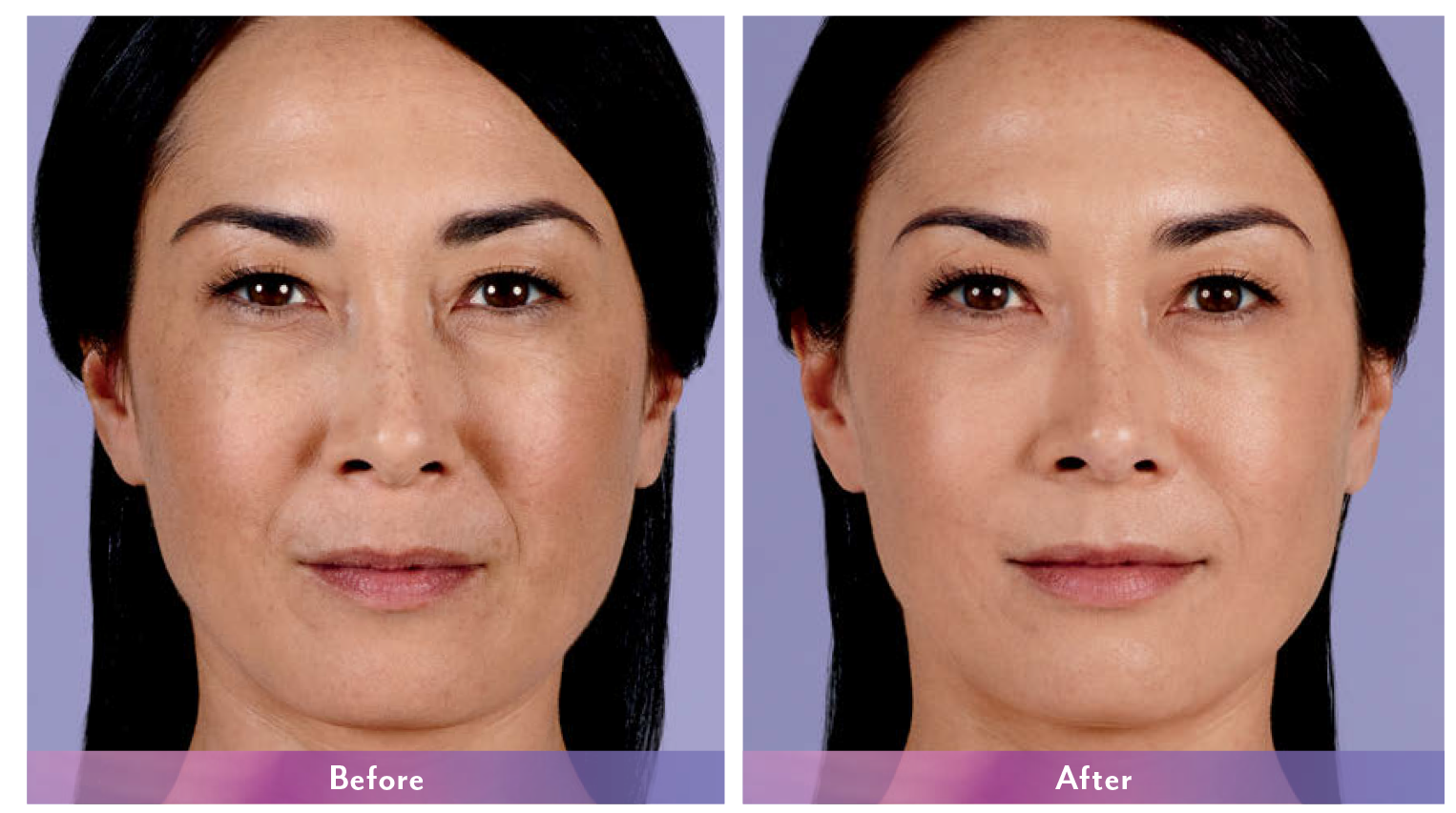 Juvederm XC Before and After 2