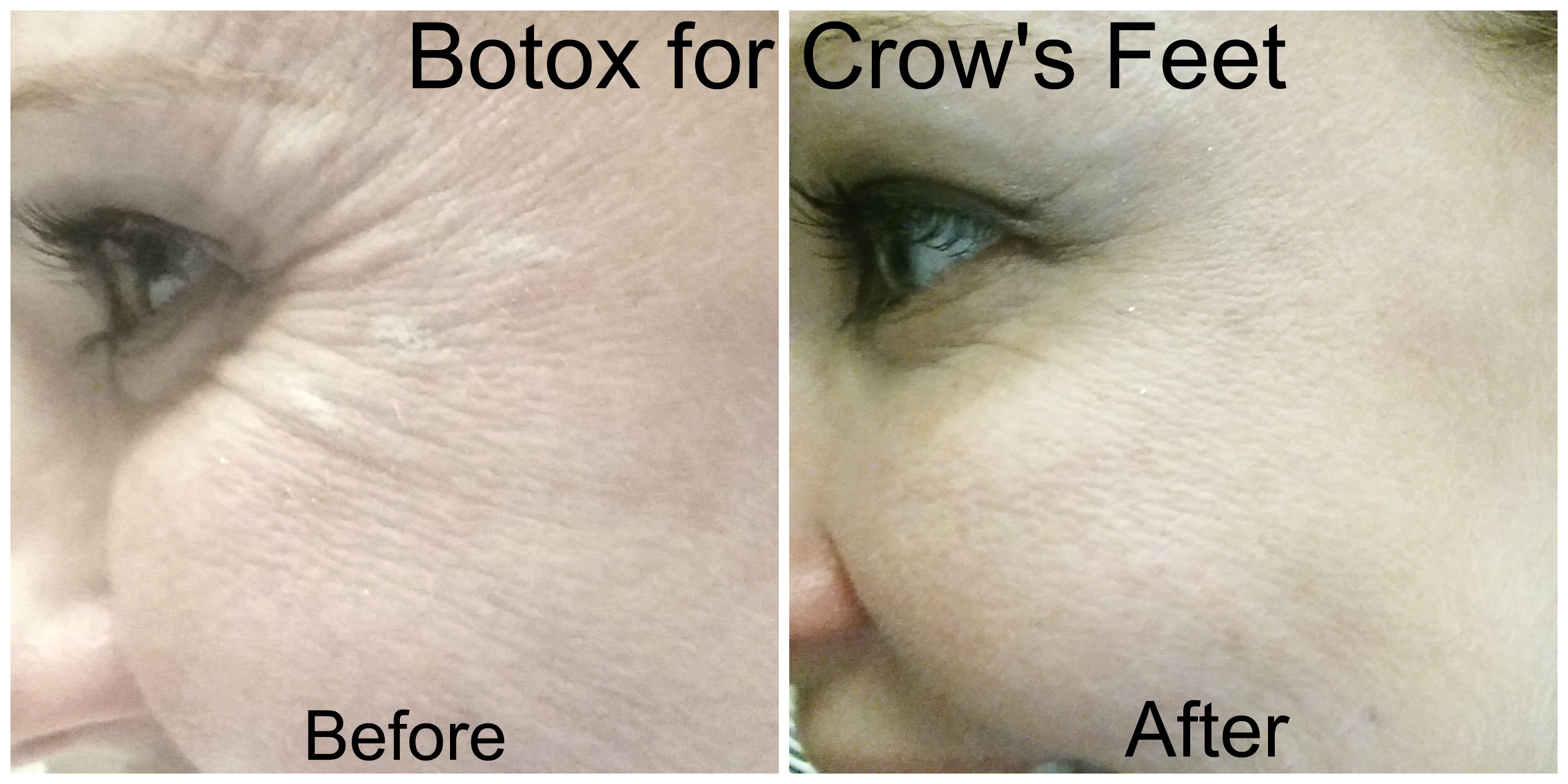 Botox Crows Feet Before and After
